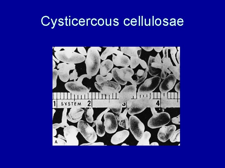 Cysticercous cellulosae 