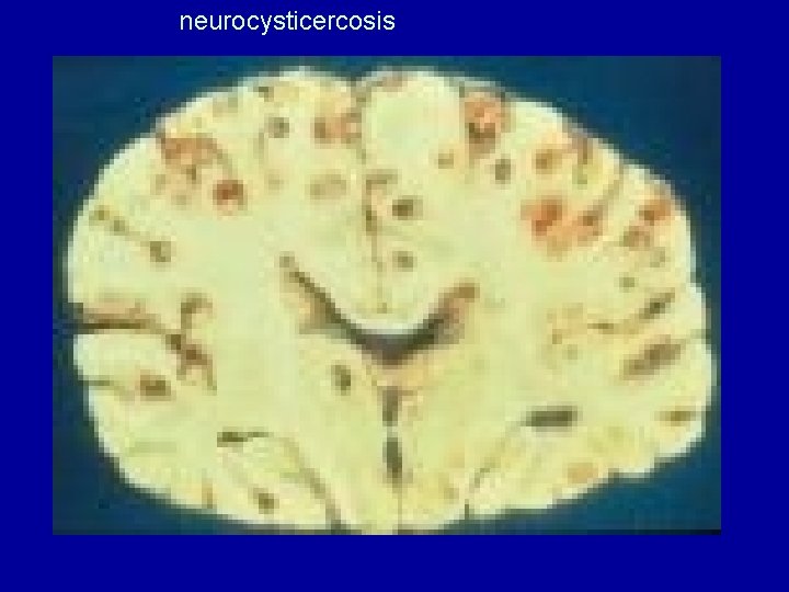 neurocysticercosis 