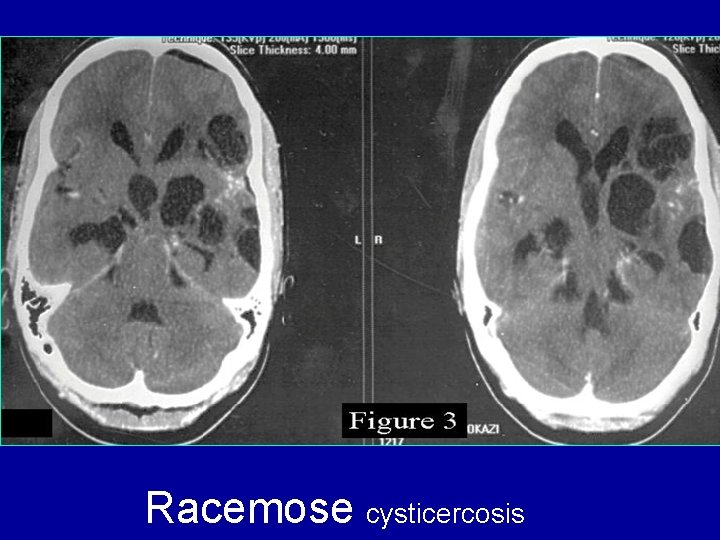 Racemose cysticercosis 