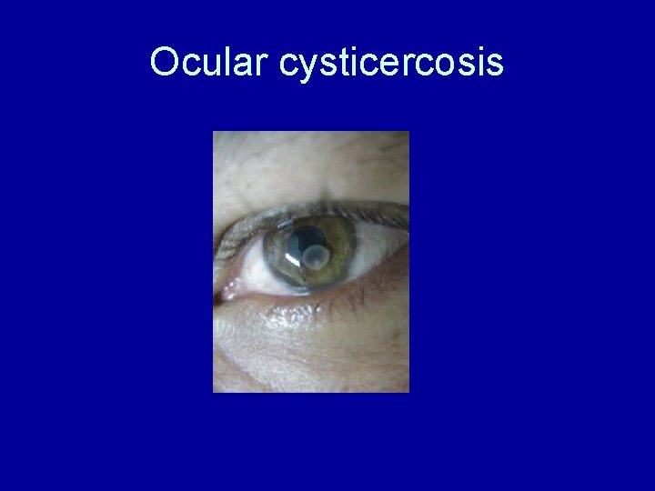 Ocular cysticercosis 