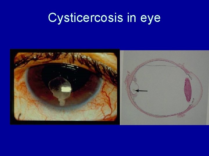 Cysticercosis in eye 