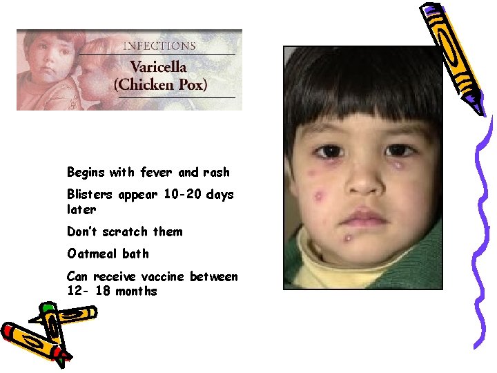Begins with fever and rash Blisters appear 10 -20 days later Don’t scratch them