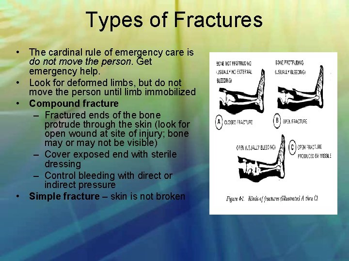 Types of Fractures • The cardinal rule of emergency care is do not move
