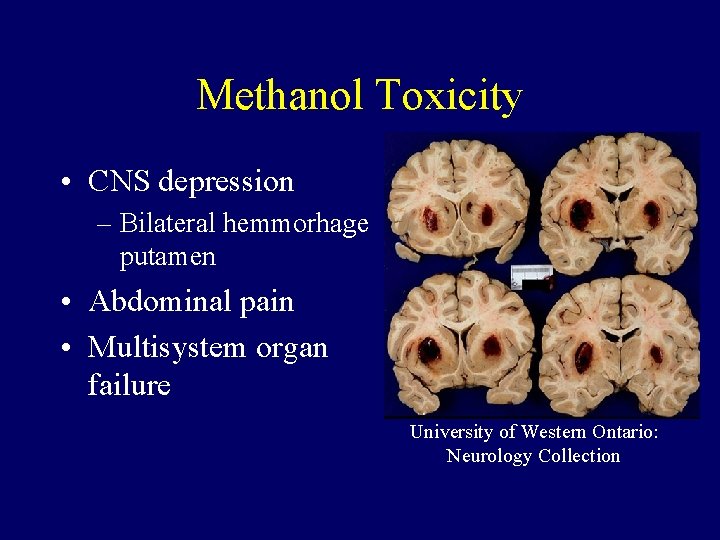 Methanol Toxicity • CNS depression – Bilateral hemmorhage putamen • Abdominal pain • Multisystem