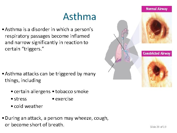 Asthma • Asthma is a disorder in which a person’s respiratory passages become inflamed