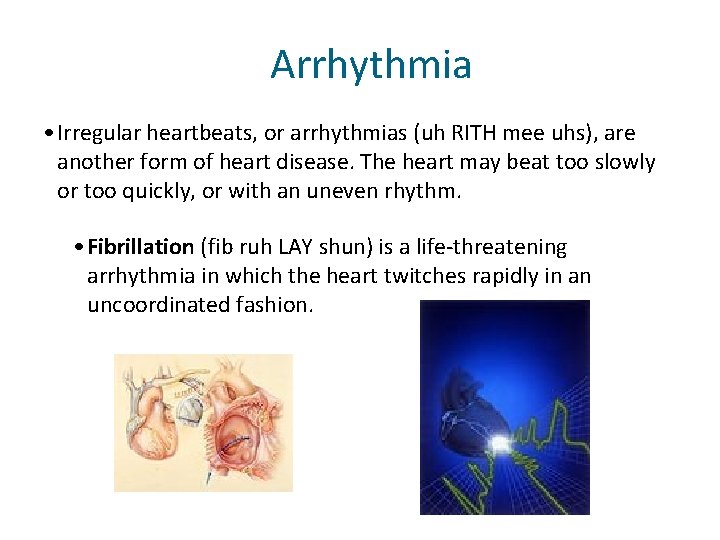 Arrhythmia • Irregular heartbeats, or arrhythmias (uh RITH mee uhs), are another form of