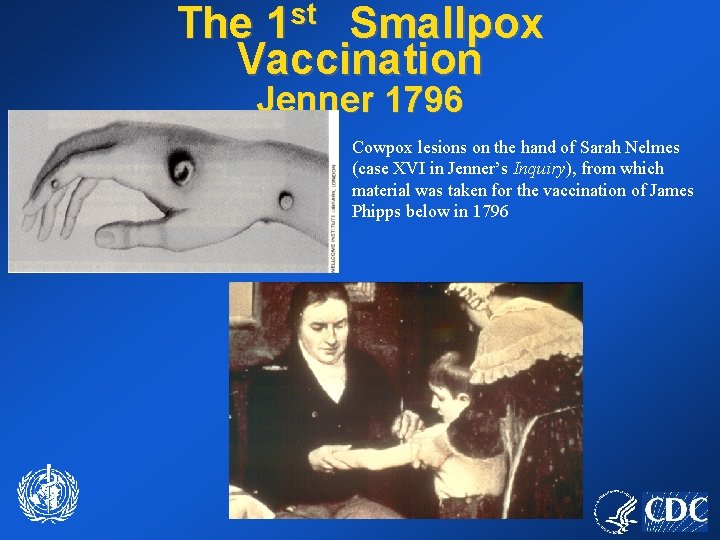 The 1 st Smallpox Vaccination Jenner 1796 Cowpox lesions on the hand of Sarah