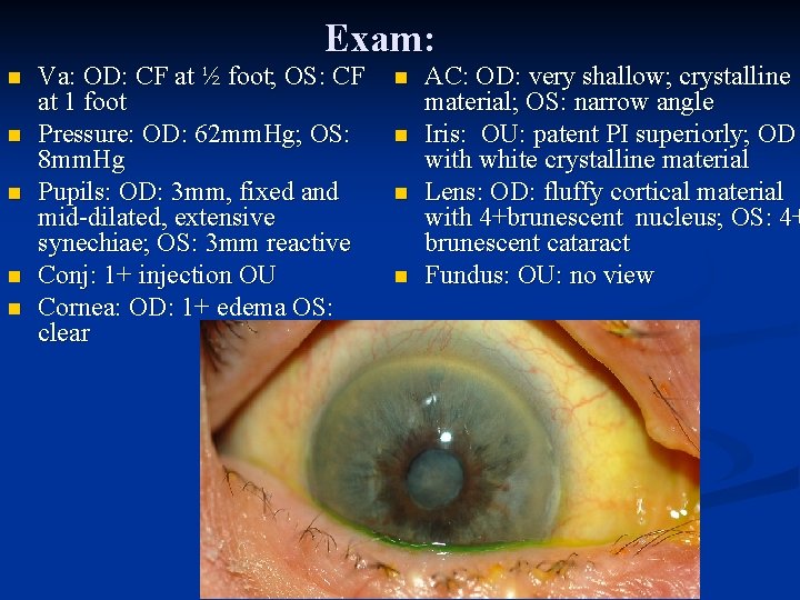 Exam: n n n Va: OD: CF at ½ foot; OS: CF at 1