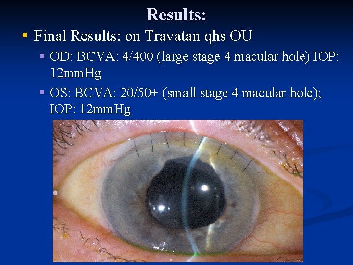 Results: § Final Results: on Travatan qhs OU § OD: BCVA: 4/400 (large stage