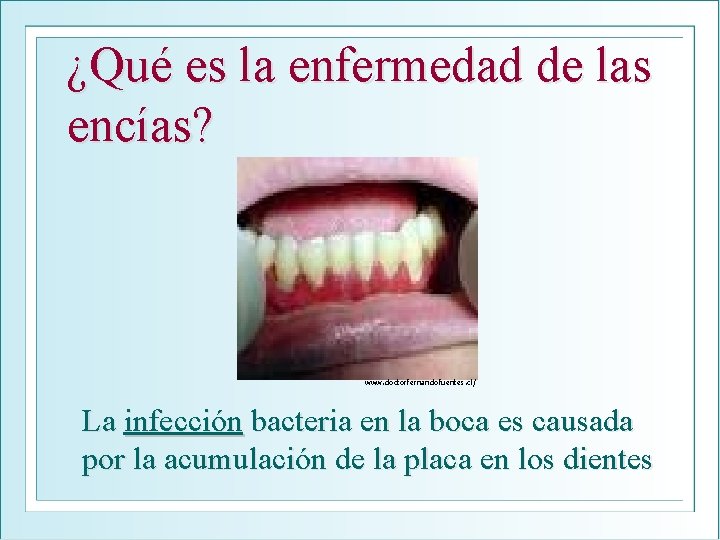 ¿Qué es la enfermedad de las encías? www. doctorfernandofuentes. cl/ La infección bacteria en