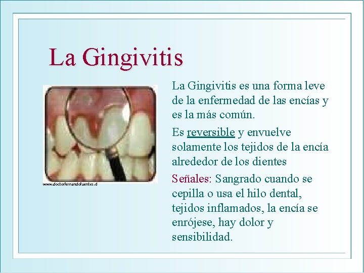 La Gingivitis www. doctorfernandofuentes. cl La Gingivitis es una forma leve de la enfermedad