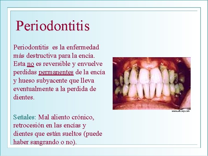 Periodontitis es la enfermedad más destructiva para la encía. Esta no es reversible y