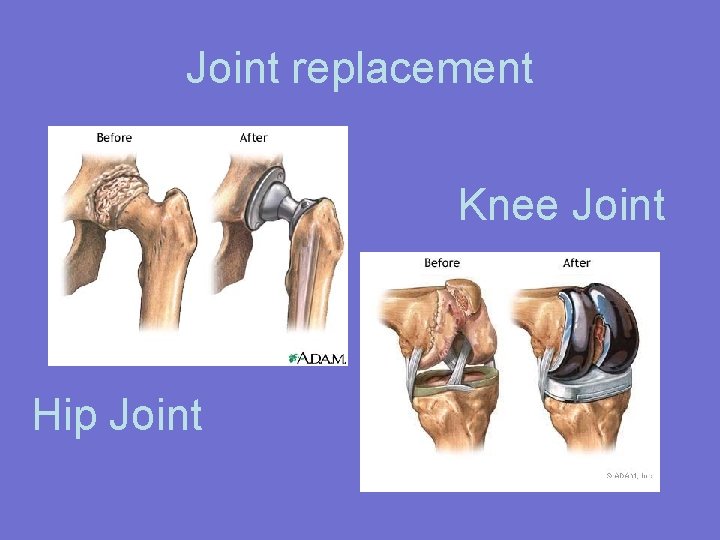 Joint replacement Knee Joint Hip Joint 