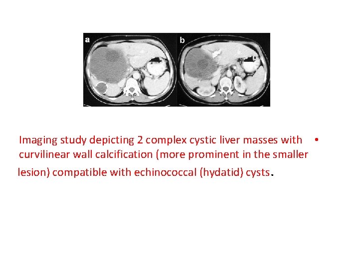 Imaging study depicting 2 complex cystic liver masses with • curvilinear wall calcification (more