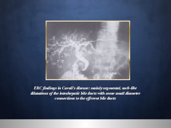 ERC findings in Caroli’s disease: mainly segmental, sack-like dilatations of the intrahepatic bile ducts