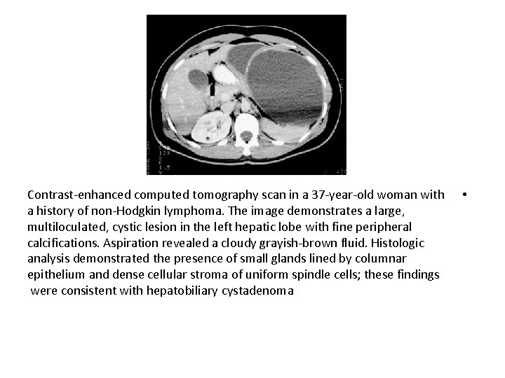 Contrast-enhanced computed tomography scan in a 37 -year-old woman with a history of non-Hodgkin