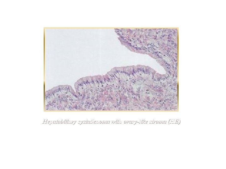 Hepatobiliary cystadenoma with ovary-like stroma (HE) 