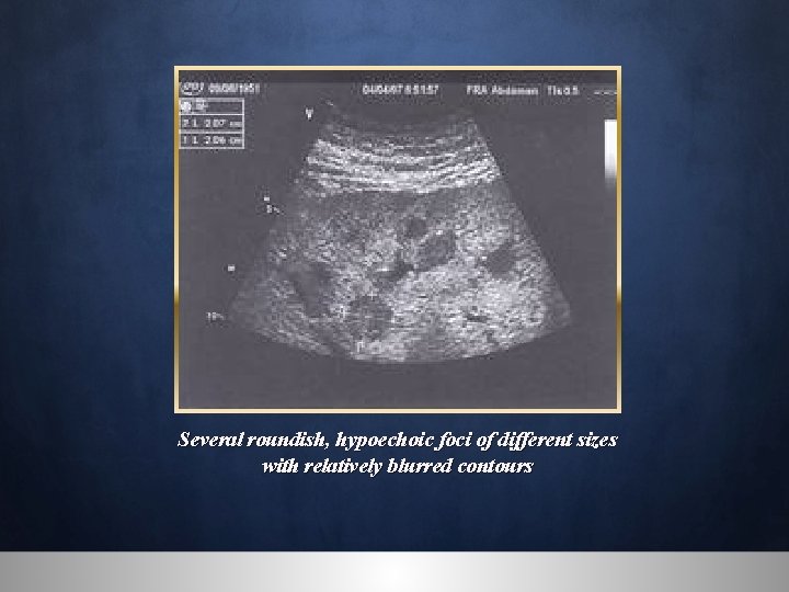 Several roundish, hypoechoic foci of different sizes with relatively blurred contours 