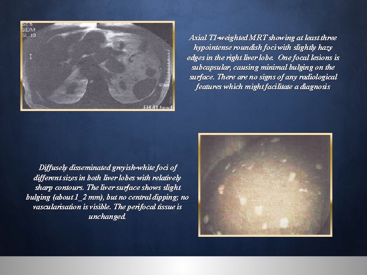 Axial T 1 -weighted MRT showing at least three hypointense roundish foci with slightly