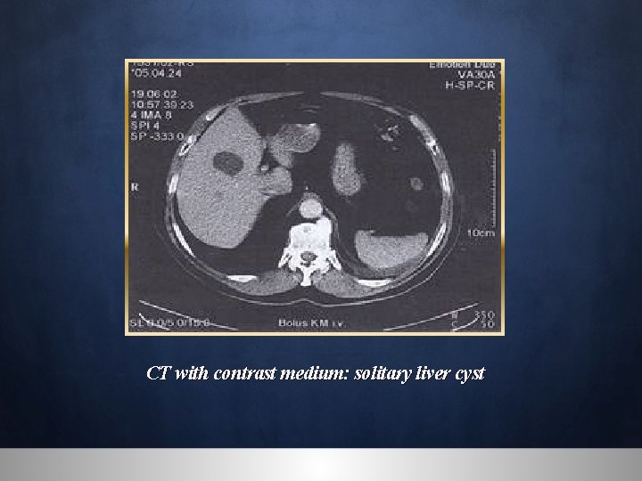 CT with contrast medium: solitary liver cyst 