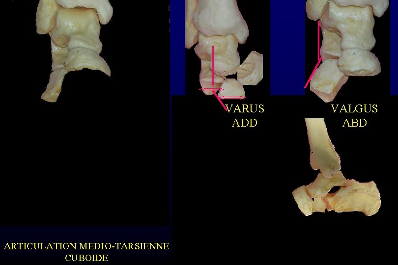 VARUS ADD ARTICULATION MEDIO-TARSIENNE CUBOIDE VALGUS ABD 