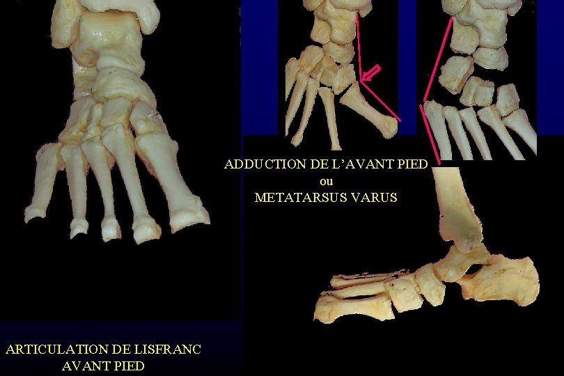 ADDUCTION DE L’AVANT PIED ou METATARSUS VARUS ARTICULATION DE LISFRANC AVANT PIED 