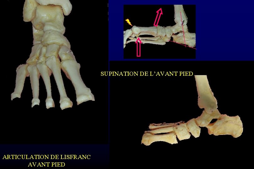 SUPINATION DE L’AVANT PIED ARTICULATION DE LISFRANC AVANT PIED 