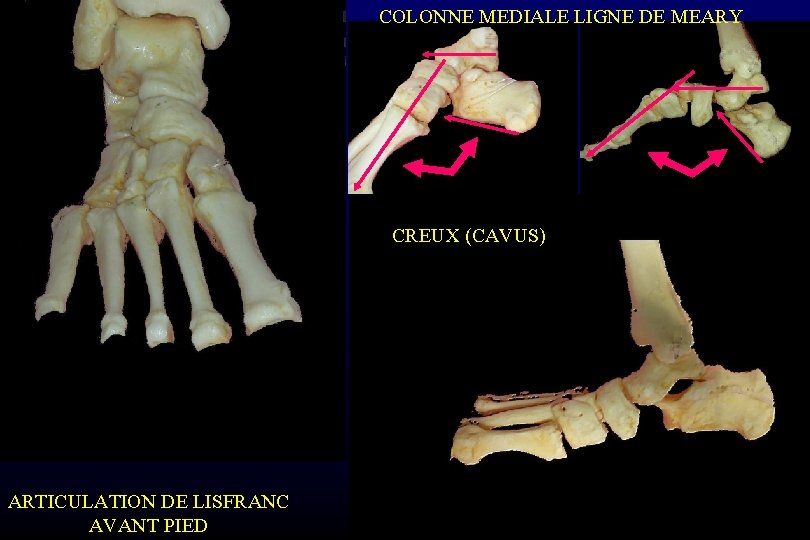 COLONNE MEDIALE LIGNE DE MEARY CREUX (CAVUS) ARTICULATION DE LISFRANC AVANT PIED 