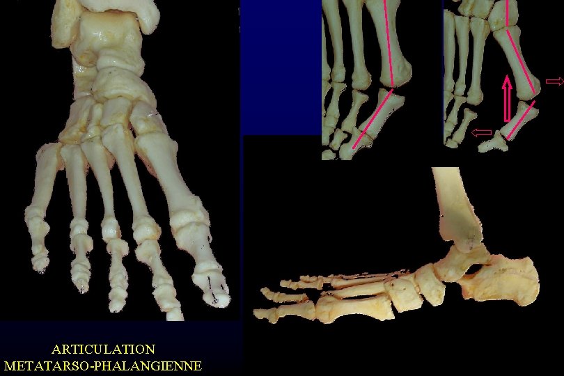 ARTICULATION METATARSO-PHALANGIENNE 