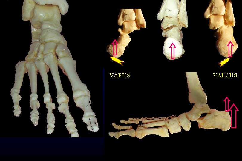 VARUS VALGUS 