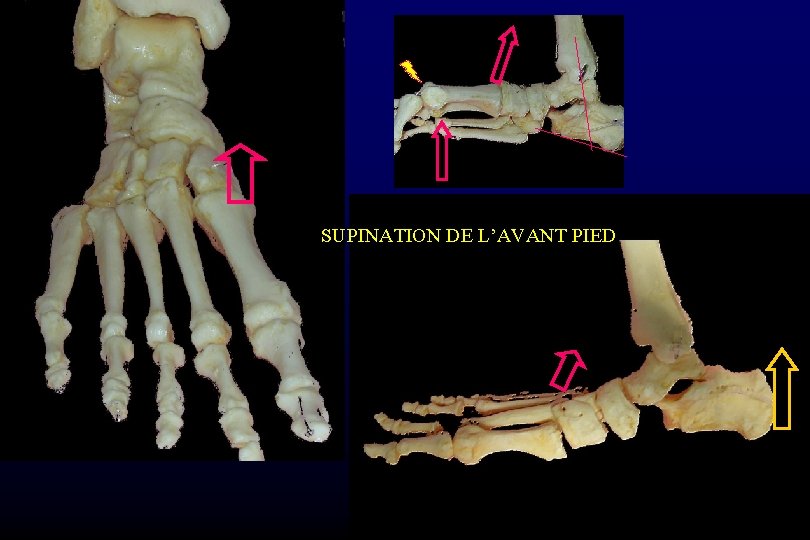 SUPINATION DE L’AVANT PIED 