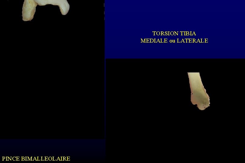 TORSION TIBIA MEDIALE ou LATERALE PINCE BIMALLEOLAIRE 
