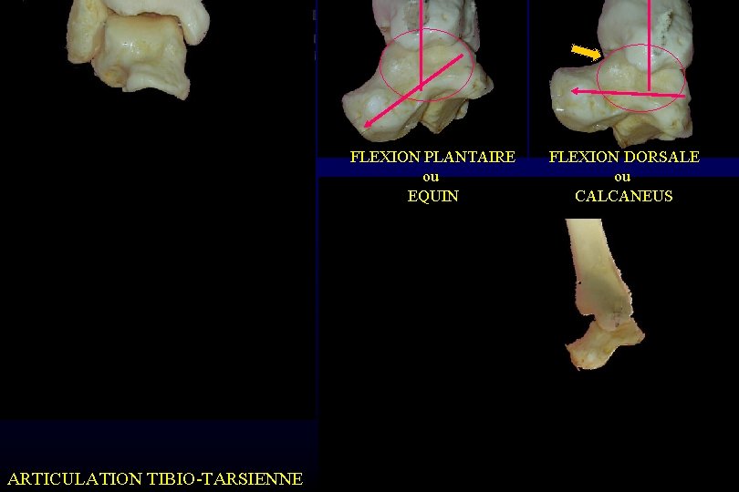 FLEXION PLANTAIRE ou EQUIN ARTICULATION TIBIO-TARSIENNE FLEXION DORSALE ou CALCANEUS 