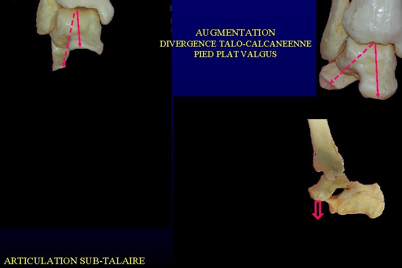 AUGMENTATION DIVERGENCE TALO-CALCANEENNE PIED PLAT VALGUS ARTICULATION SUB-TALAIRE 