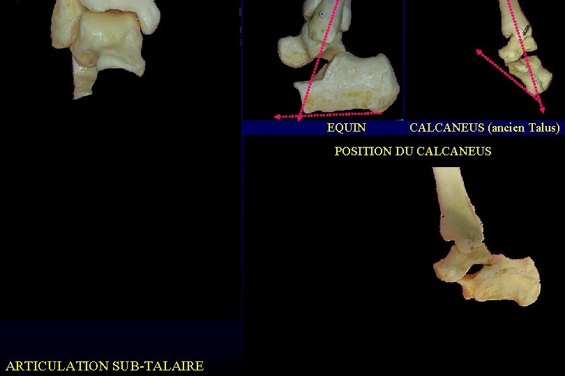 EQUIN CALCANEUS (ancien Talus) POSITION DU CALCANEUS ARTICULATION SUB-TALAIRE 