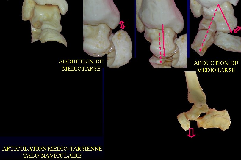 ADDUCTION DU MEDIOTARSE ARTICULATION MEDIO-TARSIENNE TALO-NAVICULAIRE ABDUCTION DU MEDIOTARSE 