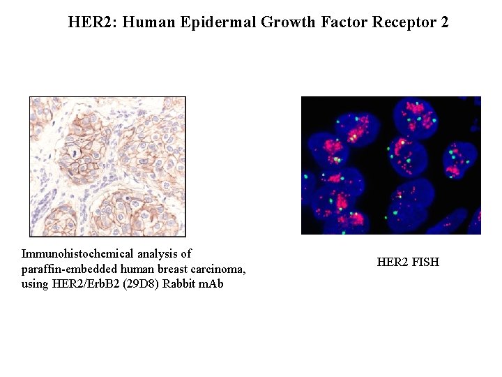 HER 2: Human Epidermal Growth Factor Receptor 2 Immunohistochemical analysis of paraffin-embedded human breast