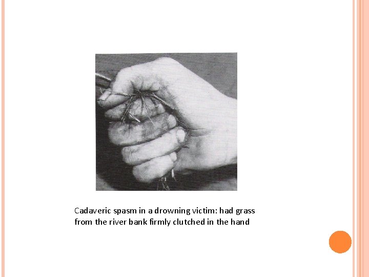 Cadaveric spasm in a drowning victim: had grass from the river bank firmly clutched