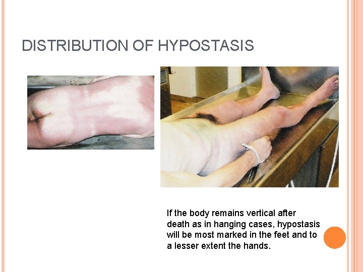 DISTRIBUTION OF HYPOSTASIS If the body remains vertical after death as in hanging cases,