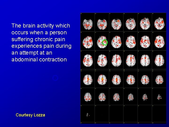 The brain activity which occurs when a person suffering chronic pain experiences pain during