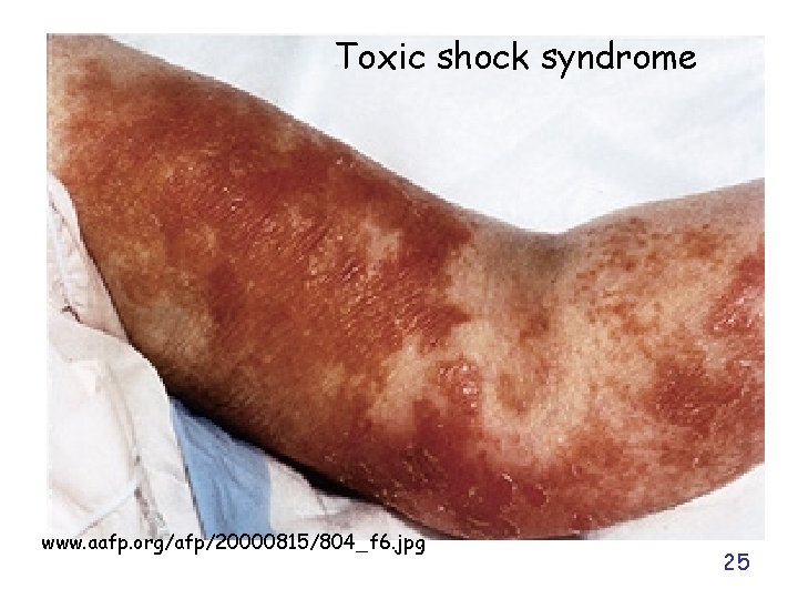 Toxic shock syndrome www. aafp. org/afp/20000815/804_f 6. jpg 25 