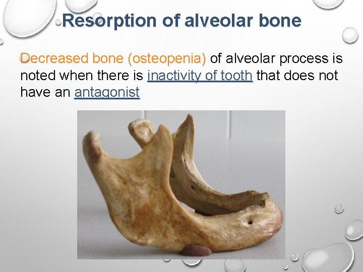 Resorption of alveolar bone Decreased bone (osteopenia) of alveolar process is noted when there