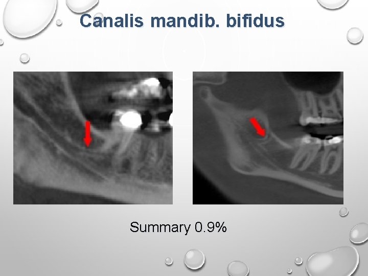 Canalis mandib. bifidus Summary 0. 9% 