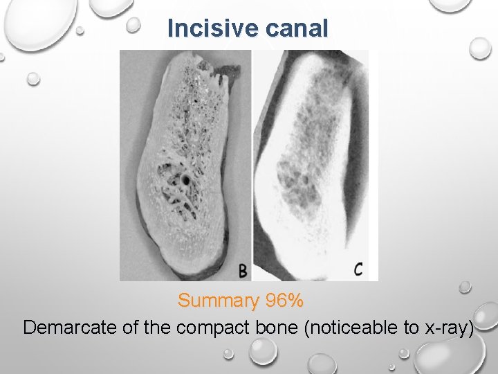 Incisive canal Summary 96% Demarcate of the compact bone (noticeable to x-ray) Incisive canal Summary 96% Demarcate of the compact bone (noticeable to x-ray)