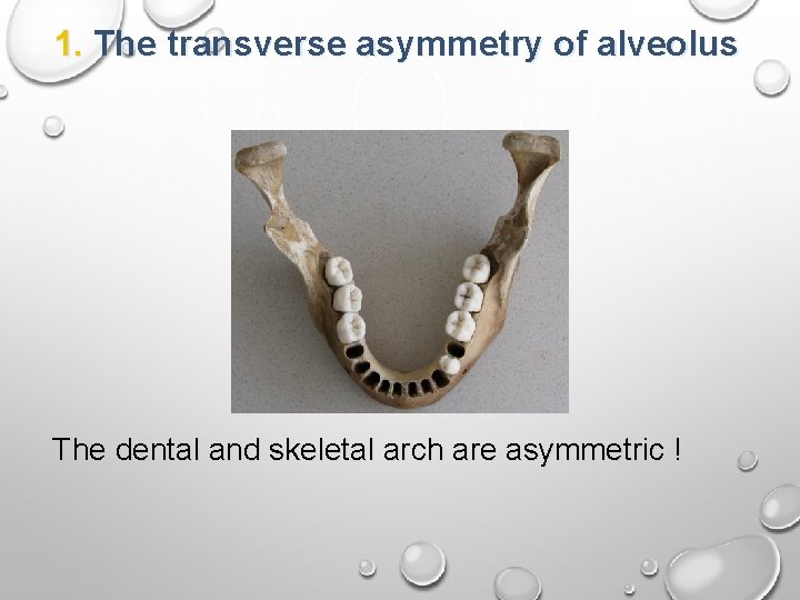 1. The transverse asymmetry of alveolus The dental and skeletal arch are asymmetric !