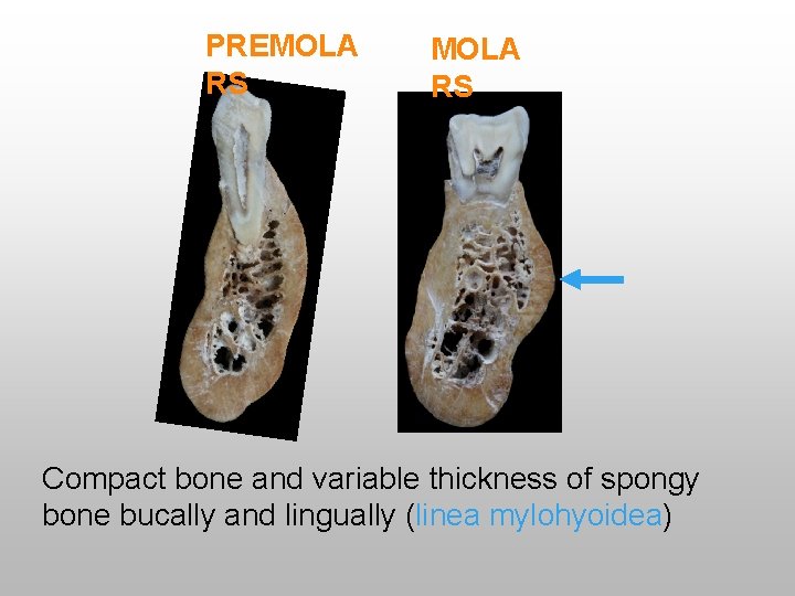 PREMOLA RS Compact bone and variable thickness of spongy bone bucally and lingually (linea