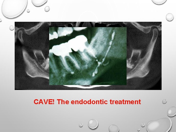 CAVE! The endodontic treatment CAVE! The endodontic treatment