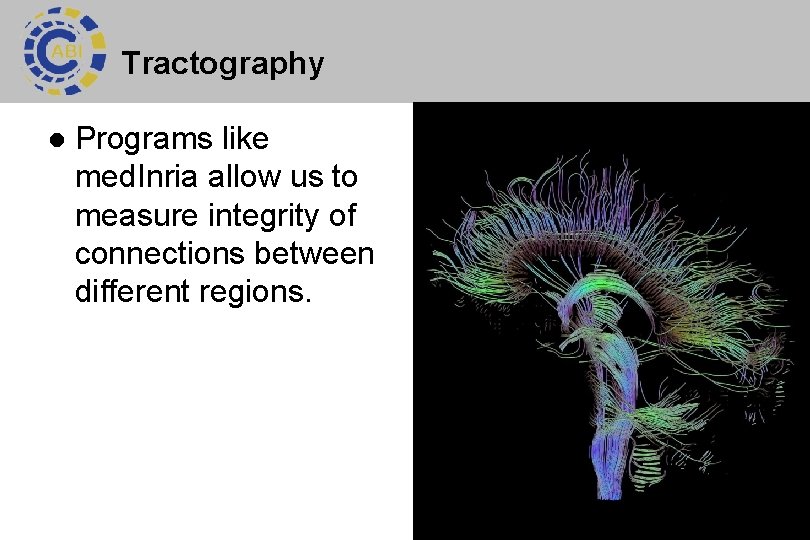 Tractography l Programs like med. Inria allow us to measure integrity of connections between