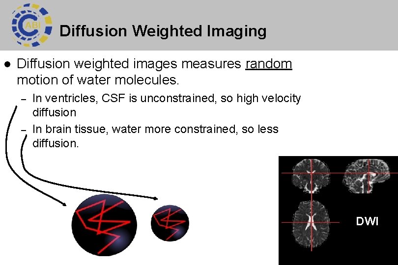 Diffusion Weighted Imaging l Diffusion weighted images measures random motion of water molecules. –