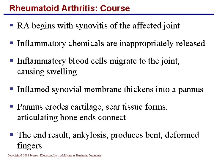 Rheumatoid Arthritis: Course § RA begins with synovitis of the affected joint § Inflammatory